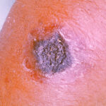 当局は炭疽病感染を防ぐためにストゥントレン州での警戒を強化