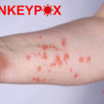 さらに2人の「サル痘」感染者を記録、国内で14症例目