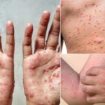 カンボジア、国境ゲートでのMpoxやその他の感染症の監視を強化