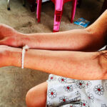 2024年　チクングニア熱の症例が前年比で74%減少