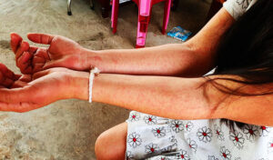 2024年　チクングニア熱の症例が前年比で74%減少