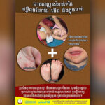 カンボジアで手足口病が増加  昔クンタボッター病院は処置ミスで乳幼児50人前後死亡のミスを犯した