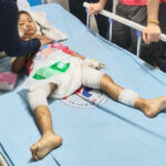 4歳の女の子が犬の群れに襲われて入院