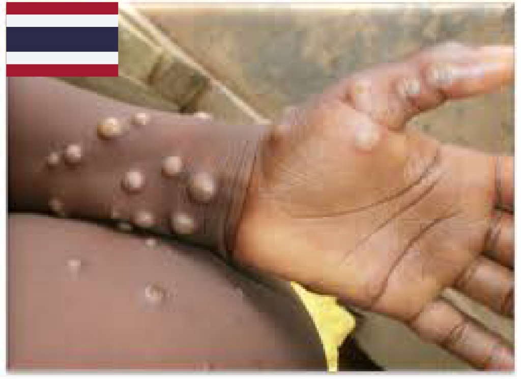 サル痘患者、タイ国内で1000人へ　政府「異常な発疹のある人との接触回避」呼びかけ