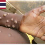 サル痘患者、タイ国内で1000人へ　政府「異常な発疹のある人との接触回避」呼びかけ