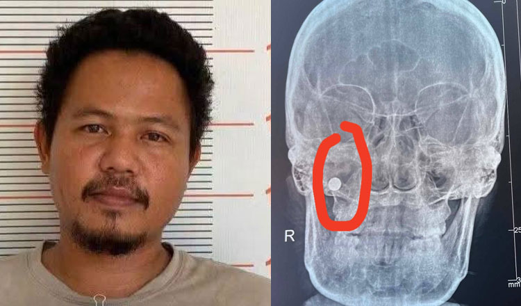 女性の顔を銃（ゴム弾）で撃った男が逮捕された